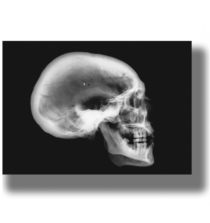 Black and white x-ray image of a human skull in profile on a black background, vintage medical wall art.