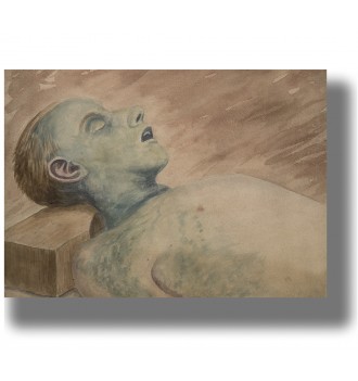 Medical illustration showing the face and chest of a man with post-mortem discolouration.