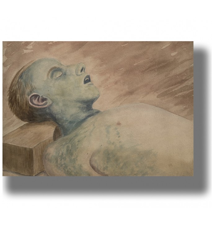 Medical illustration showing the face and chest of a man with post-mortem discolouration.